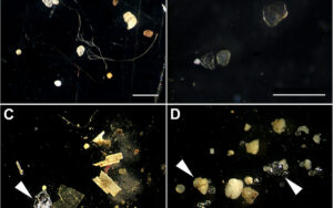 Microplastiche trovate nell’84% dei pazienti colpiti da infarto grave