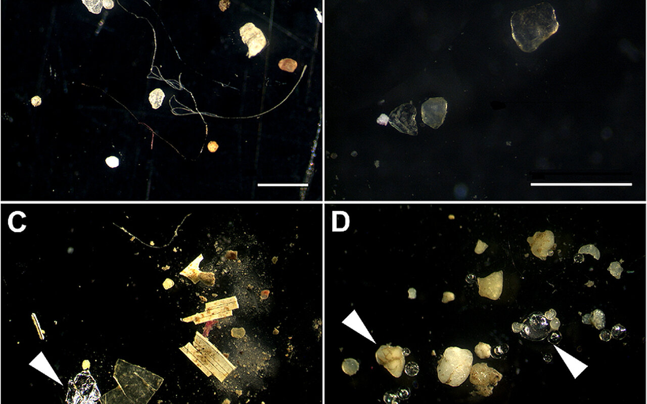 Microplastiche trovate nell’84% dei pazienti colpiti da infarto grave